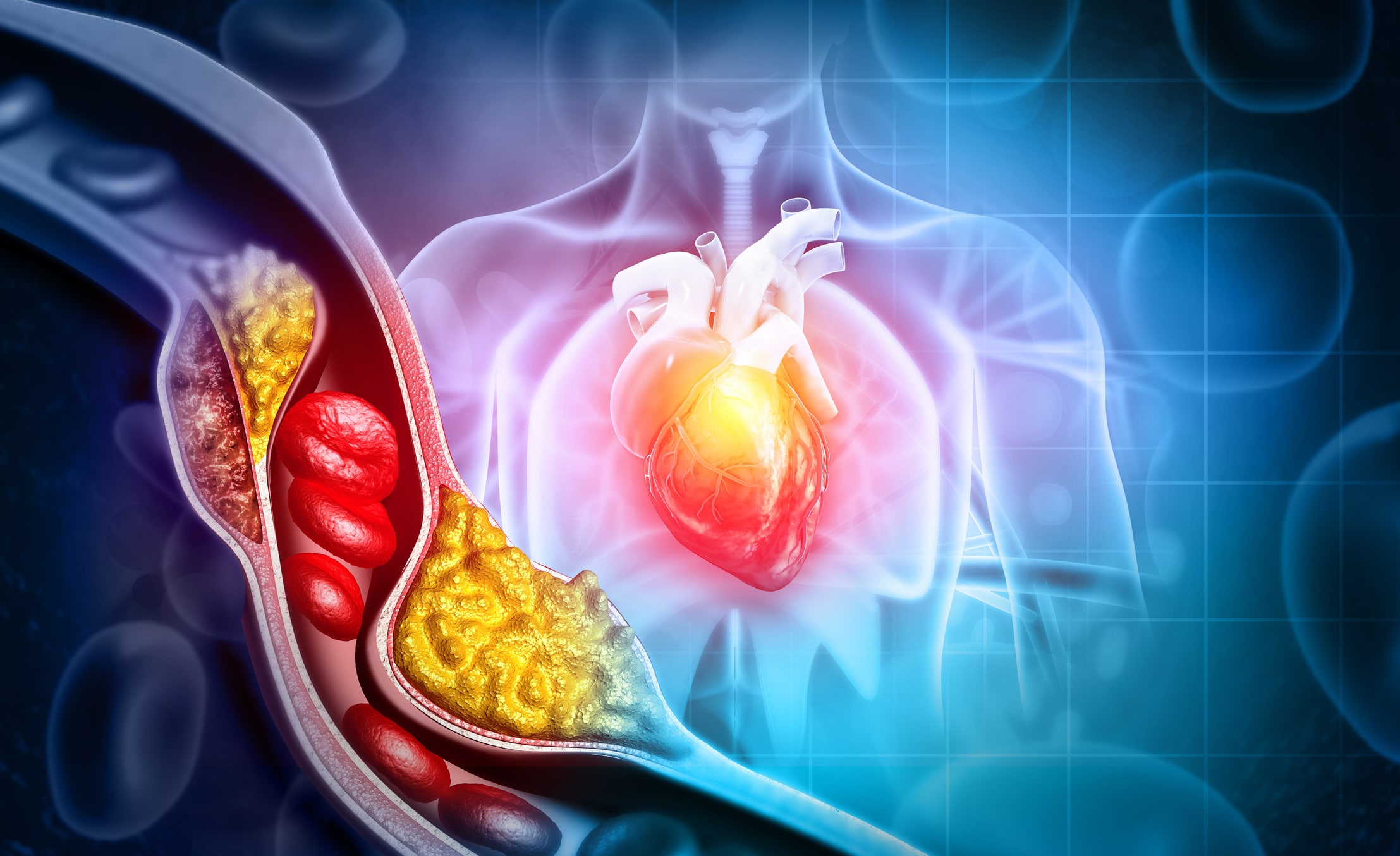Cholesterol Blocked Artery With Heart. 3D Illustration