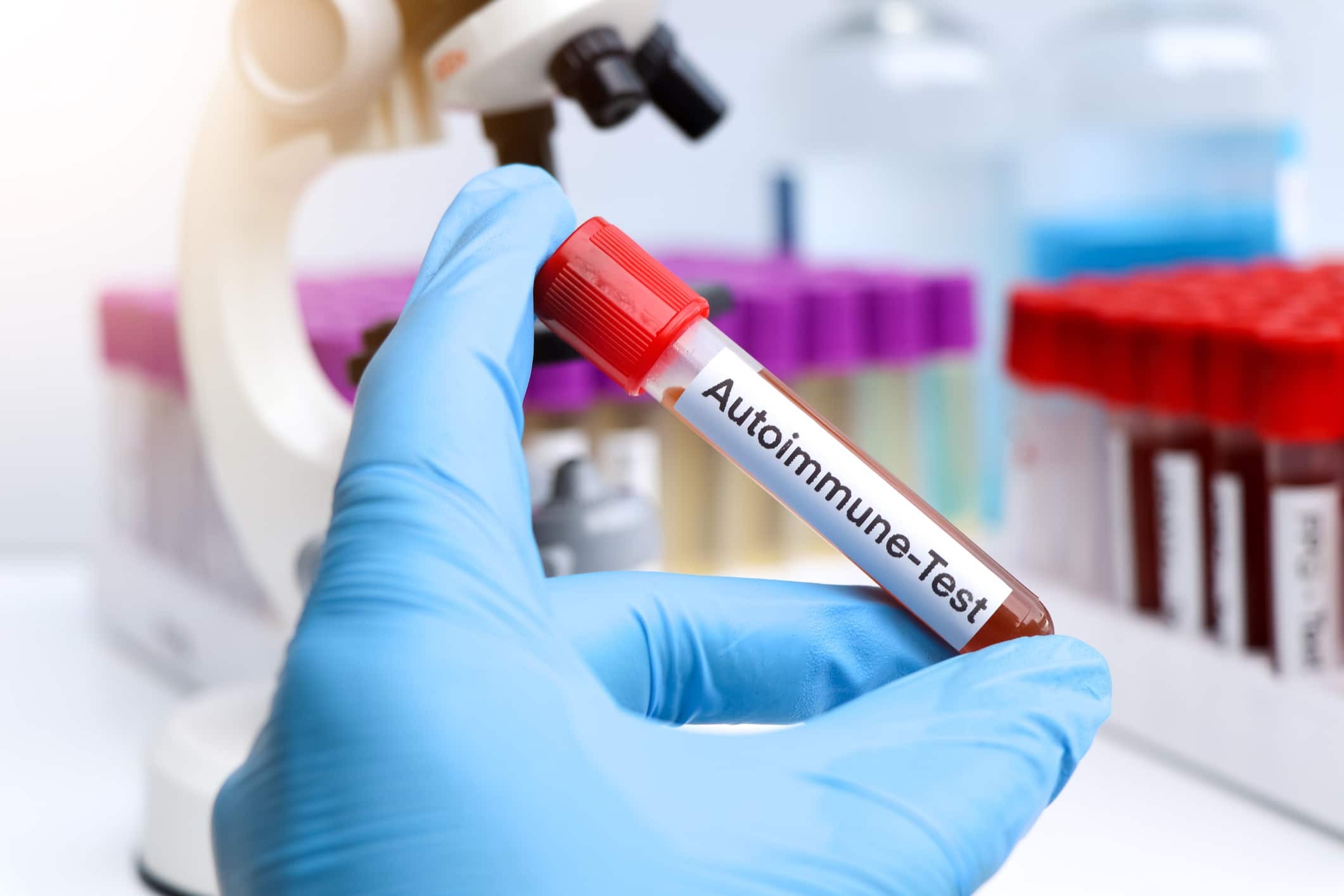 Autoimmune Test From Blood , Blood Samples To Be Analyzed In The Laboratory, Red Blood In Test Tube